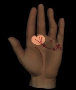 Abbildung 8: Herzmuskelschwäche: Herzlinie ist in beiden Händen dünn gezeichnet mit Gabelungen oder Quasten unter dem Mittelfinger